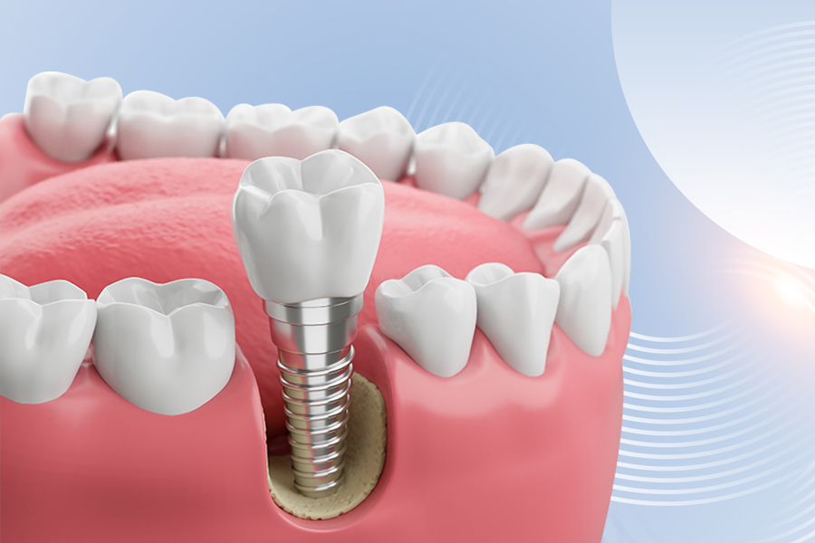 Implant Treatment