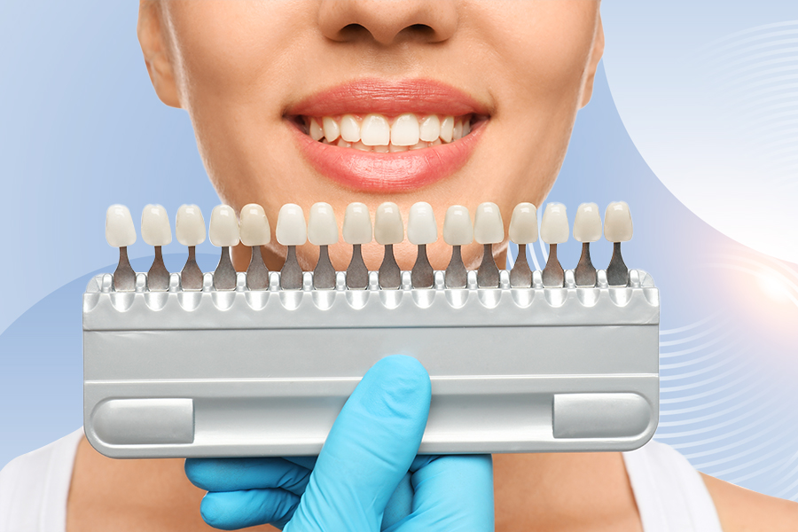 Laminated Tooth Veneers