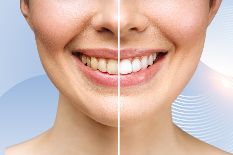 Tooth Bleaching