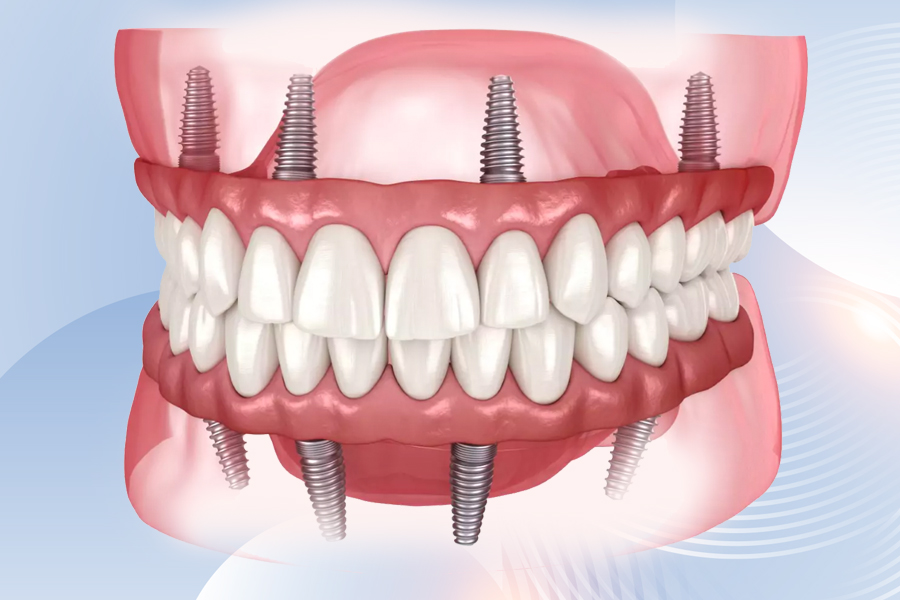 All-on-4/5/6 Dental Implants